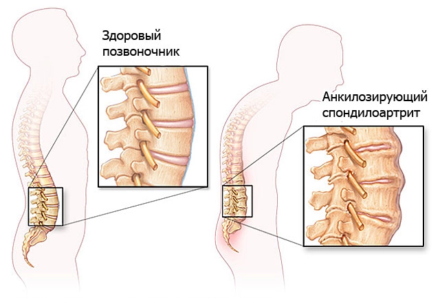 Здоровый позвоночник и анкилозирующий спондилоартрит