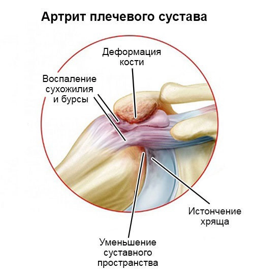 Артрит плечевого сустава
