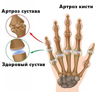 Анатомия артроза