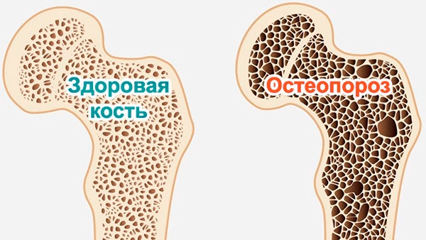 Строение кости при остеопорозе