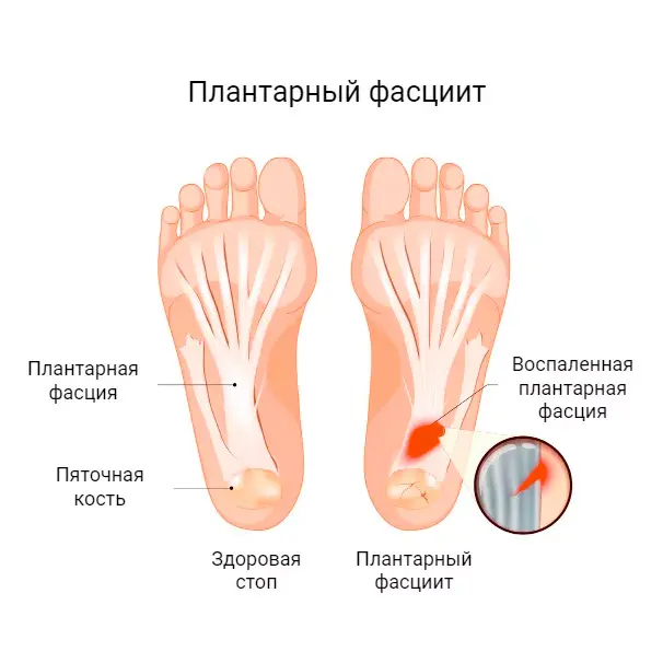 Что происходит при плантарном фасциите