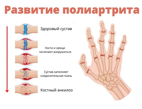 Стадии развития полиартрита