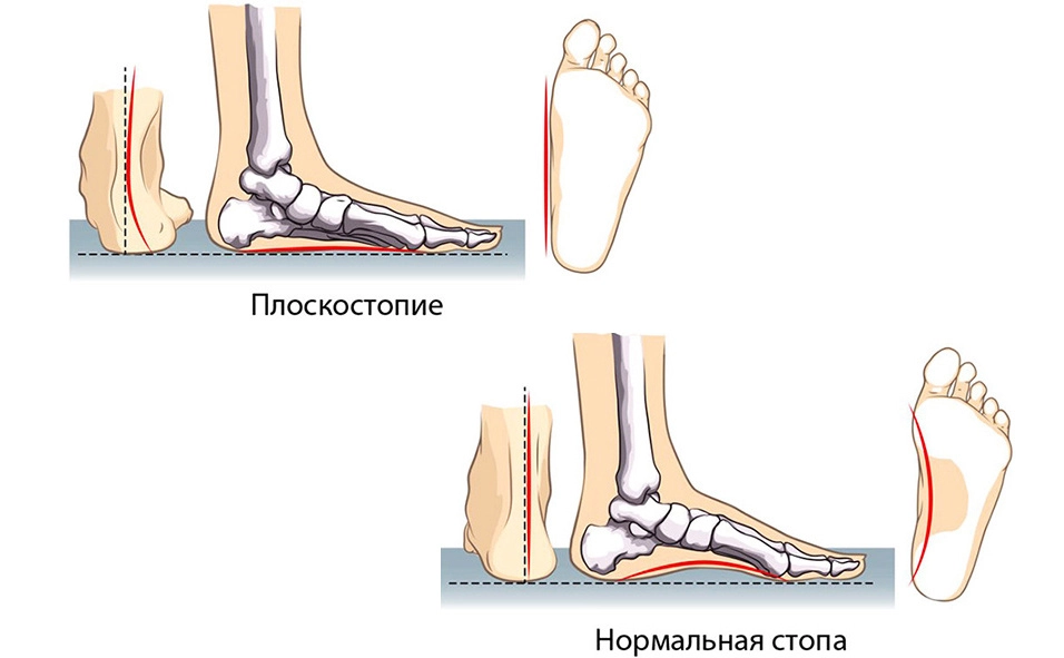 Стопа в норме и при плоскостопии