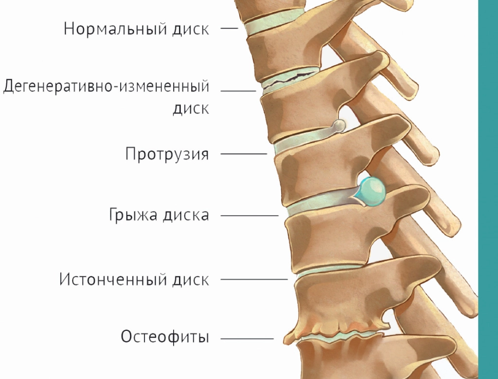 Заболевания позвоночника