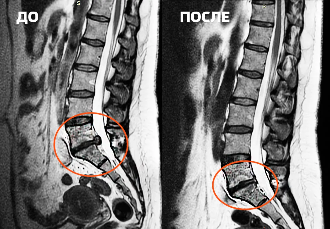 МРТ снимок колена до и после лечения в 80 лет